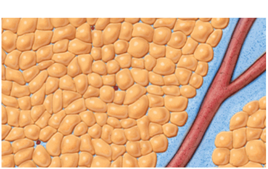 Vaser treatment during tumescent infusion