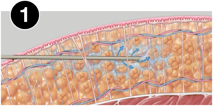 Vaser treatment during infiltration