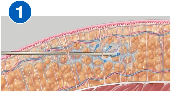 VASERlipo infiltration