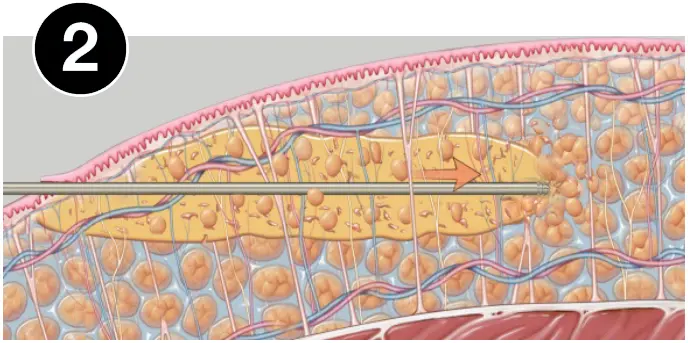 VASERlipo fragmentation