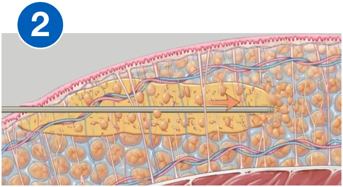 VASERlipo fragmentation