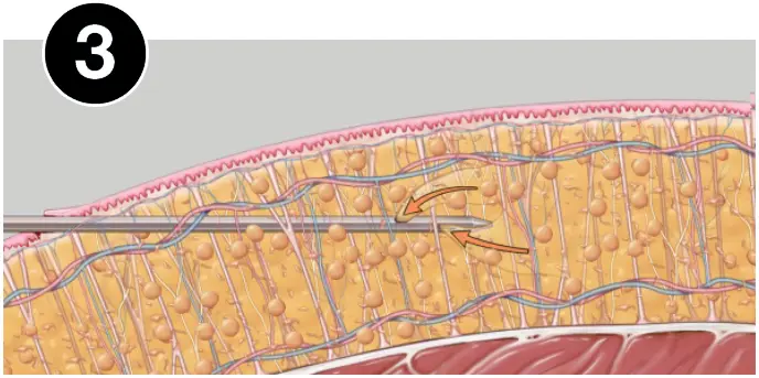 VASERlipo aspiration