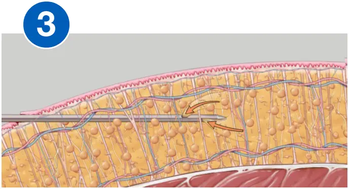 VASERlipo aspiration