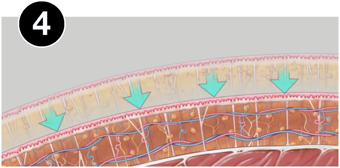 VASERlipo retraction