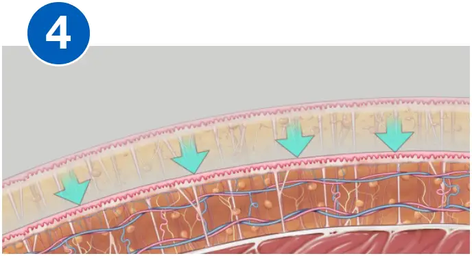 VASERlipo retraction