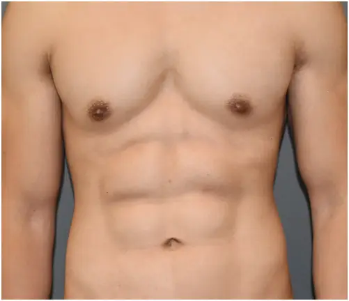 His stomach after treatment with Vaser